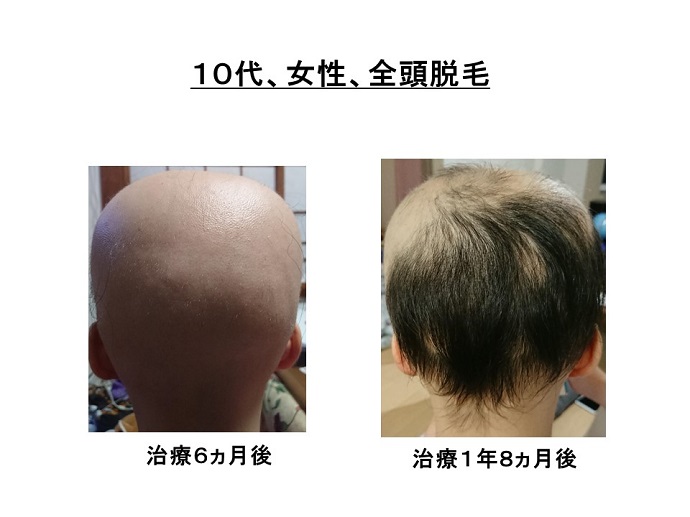 円形脱毛症　病院